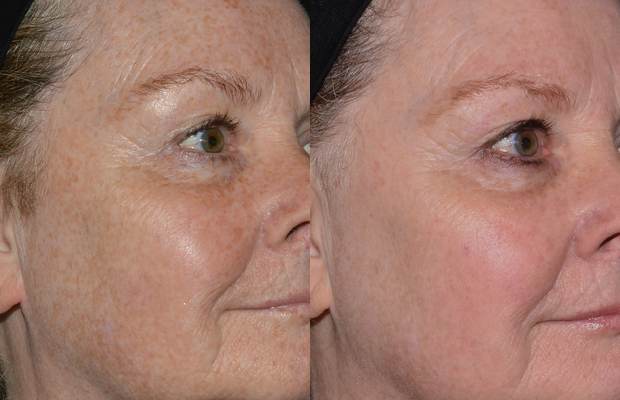 Gesichtshälfte vor und nach vier Behandlungen: Pigment und Linien gemildert