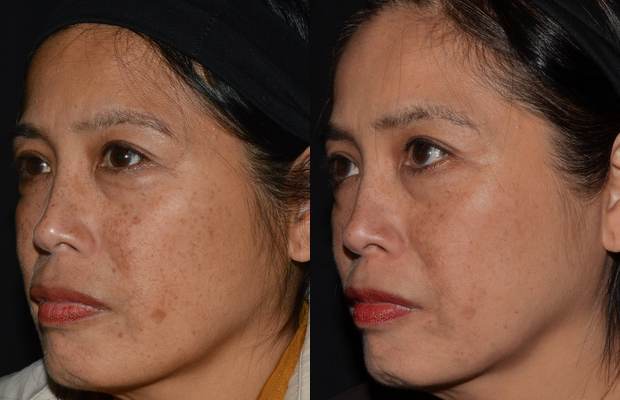 Gesicht im Halbprofil vor und nach drei Behandlungen: Melasma deutlich reduziert