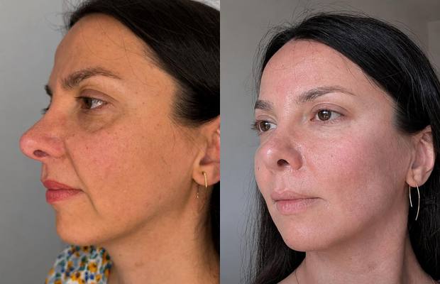 Gesicht im Halbprofil vor und nach der Behandlung: ebenmäßigerer Teint