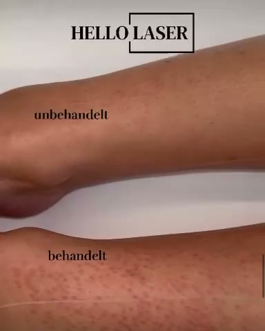 Zwei Unterschenkel direkt nach der Laserhaarentfernung: oben unbehandelt, unten behandelt mit einem roten Punkt um jede Haarwurzel